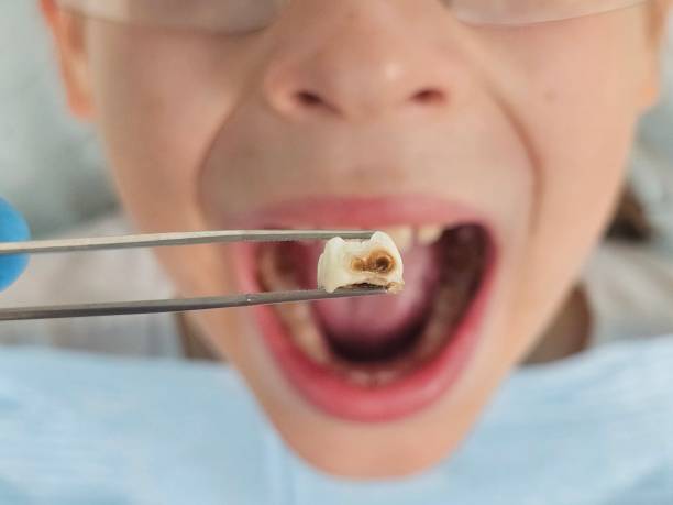 Emergency Dental Filling Replacement in SD